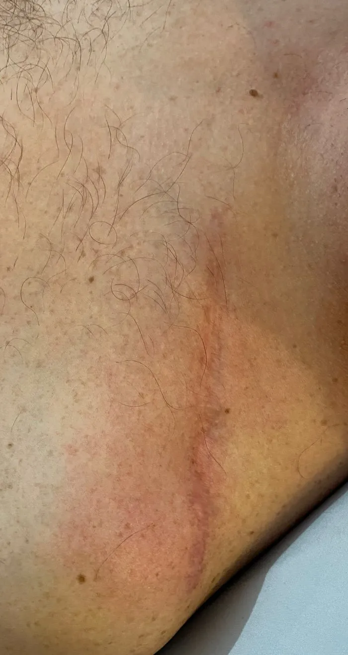 The same scar after ScarWork