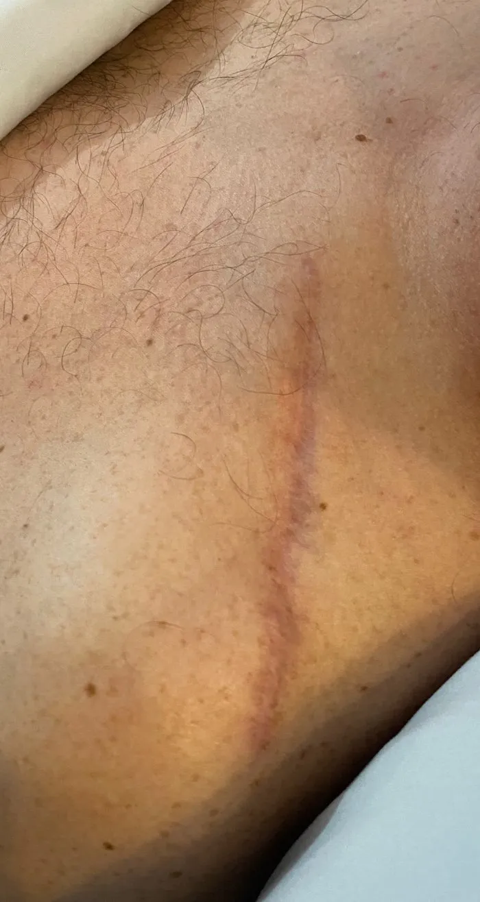 Surgical scar before ScarWork