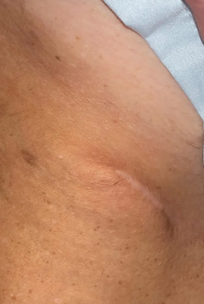 The same scar after one ScarWork session