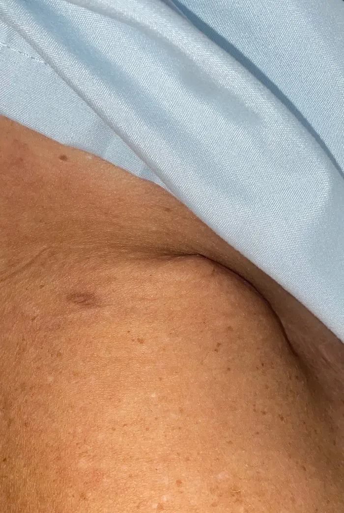 Second client's scar before ScarWork
